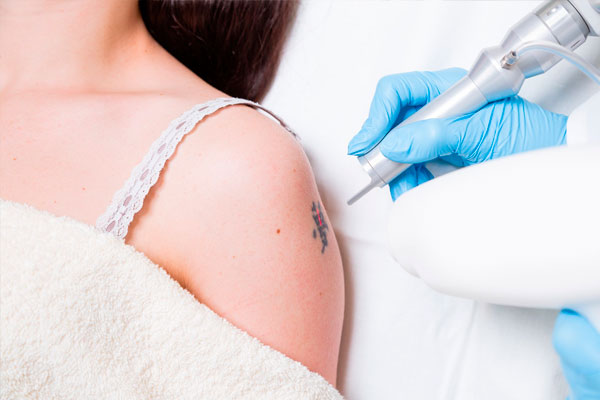 eliminación de tatuajes con láser