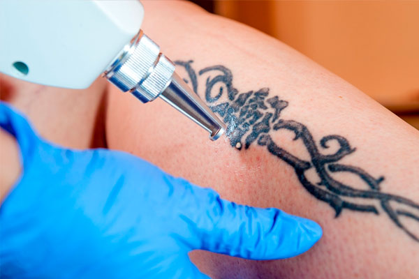 eliminación de tatuajes con láser