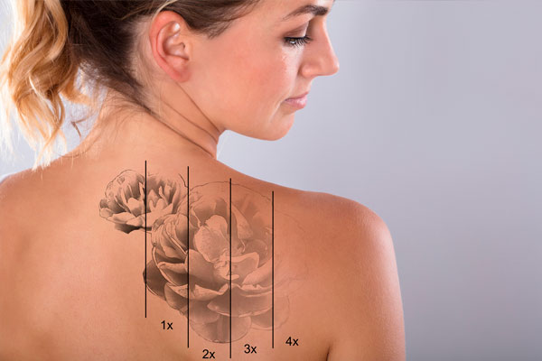 eliminación de tatuajes con láser