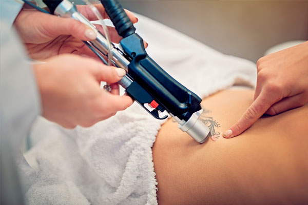 eliminación de tatuajes con láser