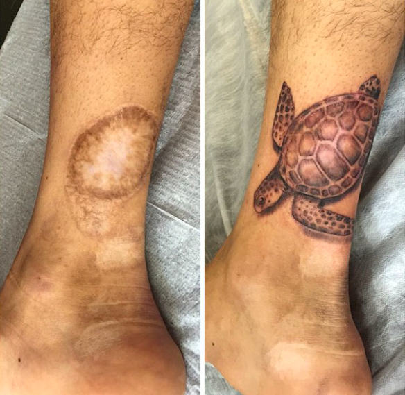 convirtiendo cicatrices en hermosos tatuajes