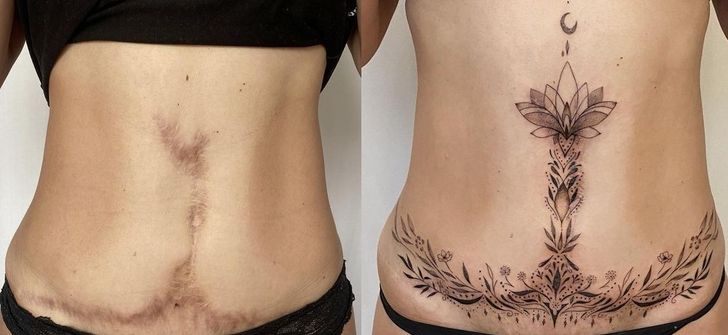 convirtiendo cicatrices en hermosos tatuajes