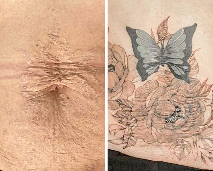 convirtiendo cicatrices en hermosos tatuajes